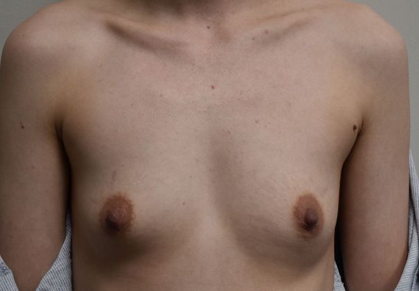 Breast Augmentation Case 636 - Before