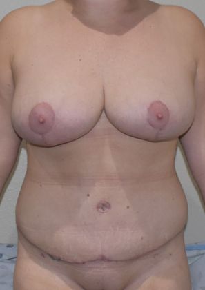 Mommy Makeover Case 188 - After