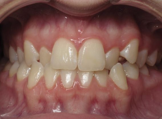 Karis Karis - Before