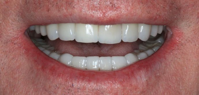 Full Mouth Reconstruction: Case 17 - After