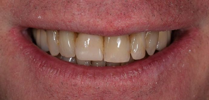 Full Mouth Reconstruction: Case 17 - Before