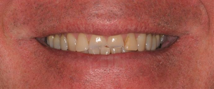 Full Mouth Reconstruction: Case 18 - Before