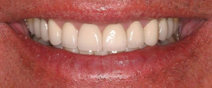 Full Mouth Reconstruction: Case 18 - After