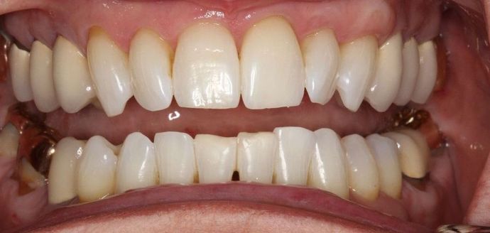 Kor Whitening: Donna - After