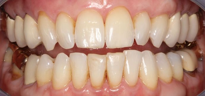 Kor Whitening: Donna - Before