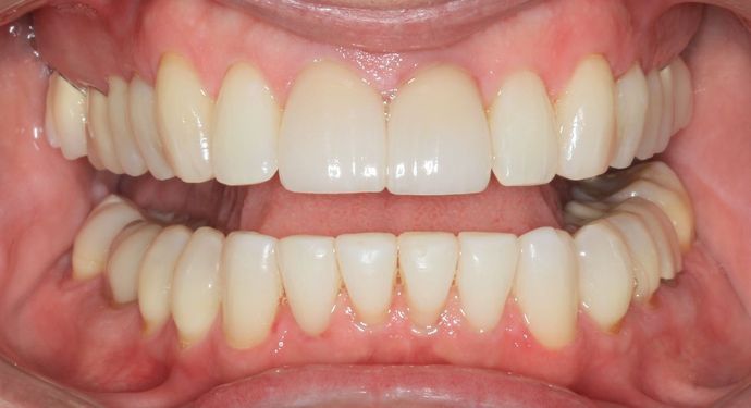 Kor Whitening: Case 3 - After