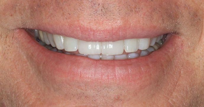 Kor Whitening: Case 3 - After