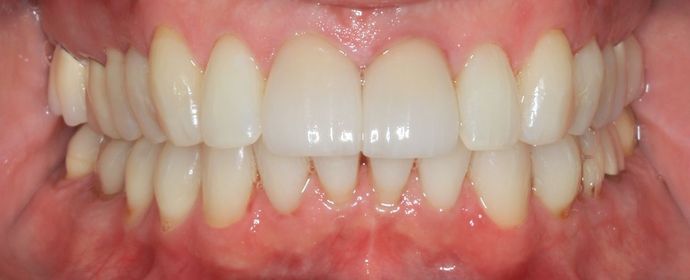 Kor Whitening: Case 3 - After