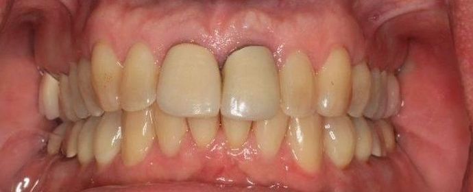 Kor Whitening: Case 3 - Before