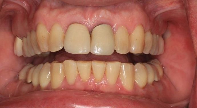 Kor Whitening: Case 3 - Before