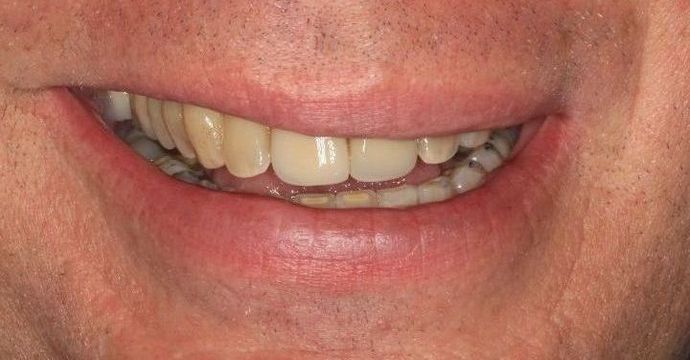 Kor Whitening: Case 3 - Before