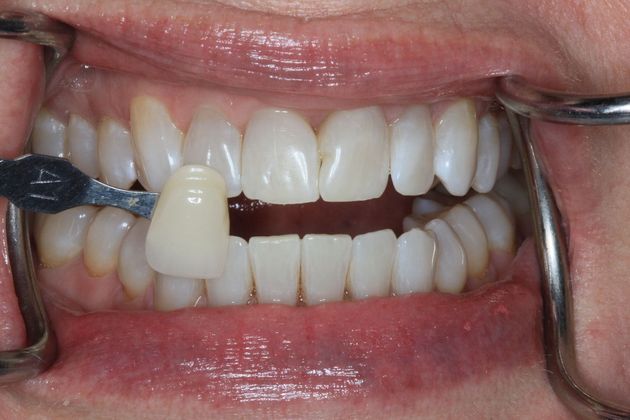 Kor Whitening: Case 4 - After
