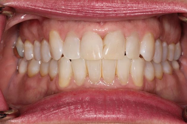 Kor Whitening: Case 4 - Before