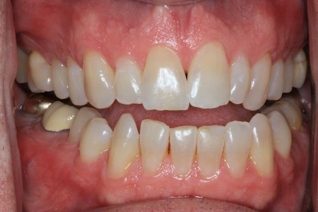 Kor Whitening: Case 5 - Before