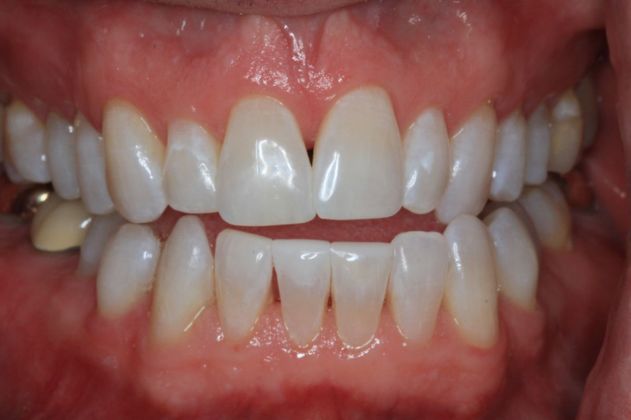 Kor Whitening: Case 5 - After