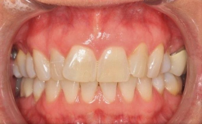 Kor Whitening: Case 6 - Before