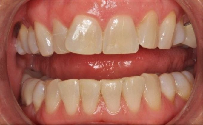 Kor Whitening: Case 6 - Before