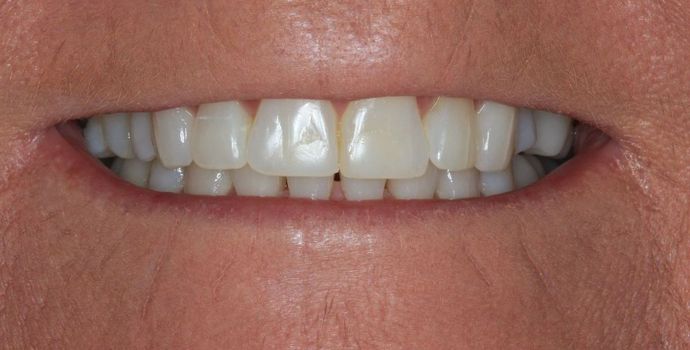 Kor Whitening Case 6 - After