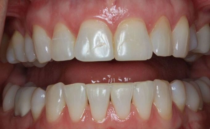 Kor Whitening: Case 6 - After