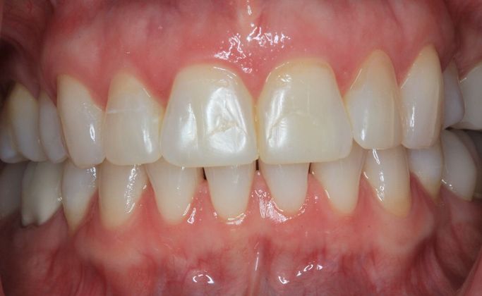 Kor Whitening: Case 6 - After