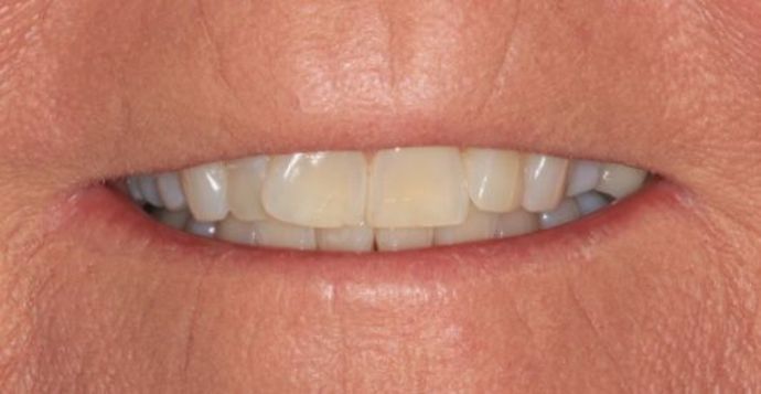 Invisalign Case 11 - Before