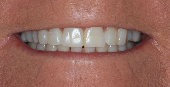 Invisalign Case 11 - After