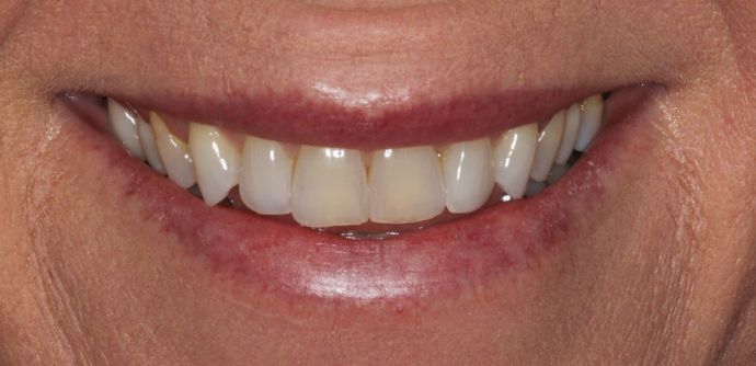 Kor Whitening Case 7 - Before