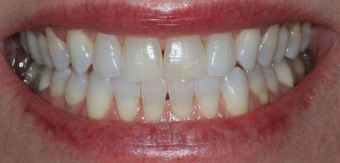 Kor Whitening Case 7 - After