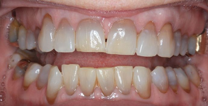 Kor Whitening: Case 8 - Before