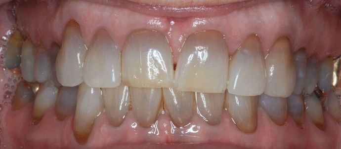 Kor Whitening: Case 8 - Before
