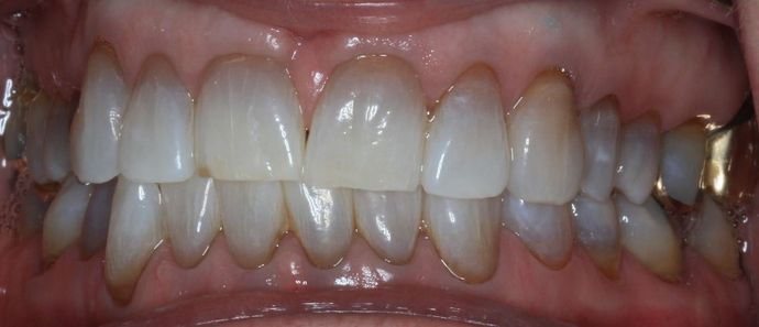 Kor Whitening: Case 8 - After