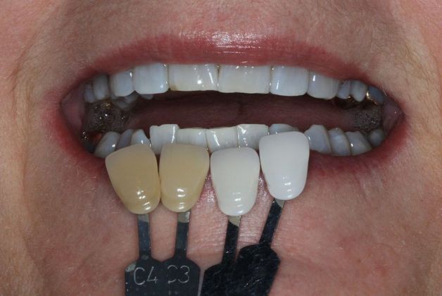 Kor Whitening: Case 8 - After