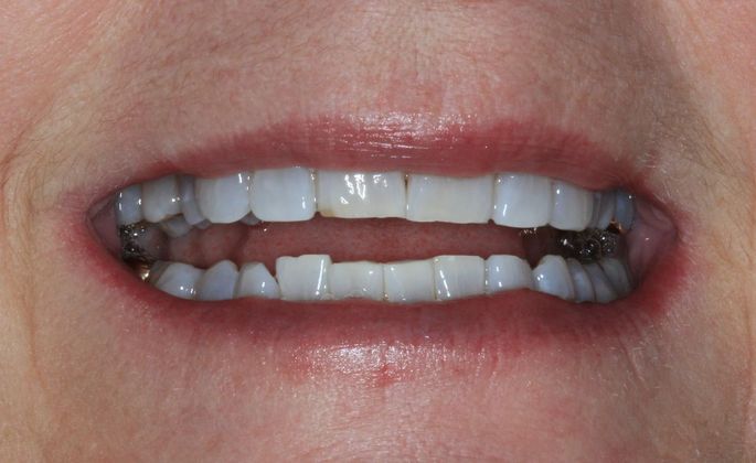 Kor Whitening Case 8 - After