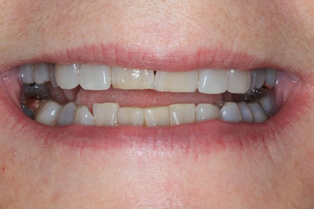 Kor Whitening: Case 8 - Before