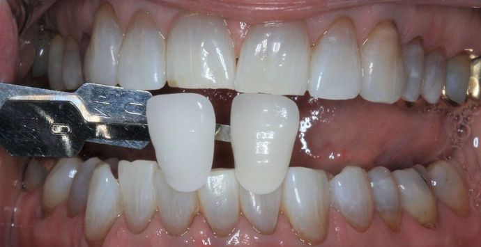 Kor Whitening: Case 8 - After