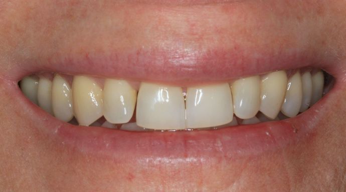 Kor Whitening Case 9 - Before