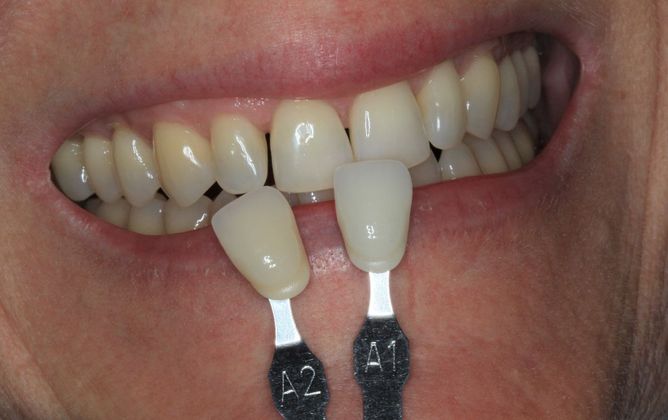 Kor Whitening: Case 9 - Before