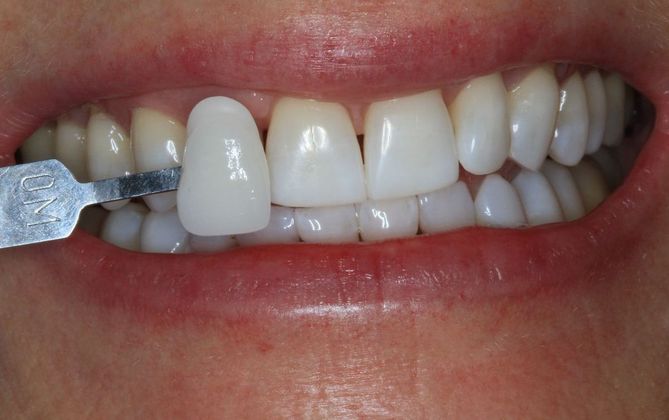 Kor Whitening: Case 9 - After