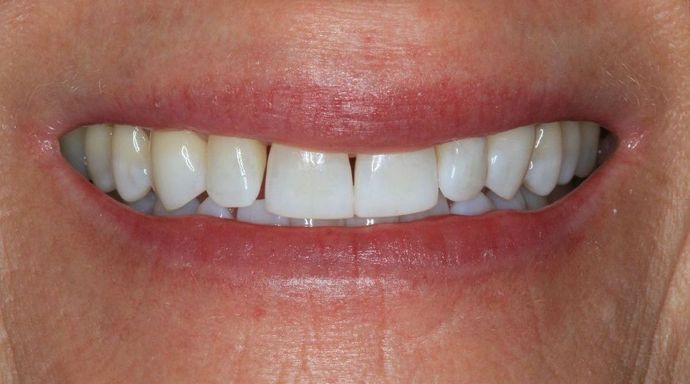 Kor Whitening Case 9 - After