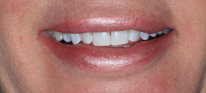After KöR Whitening procedure