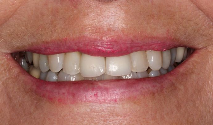 Porcelain Crowns Case 13 - Before