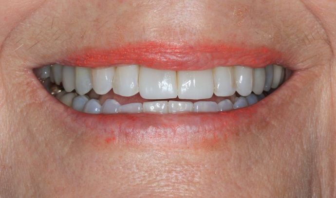 Porcelain Crowns Case 13 - After