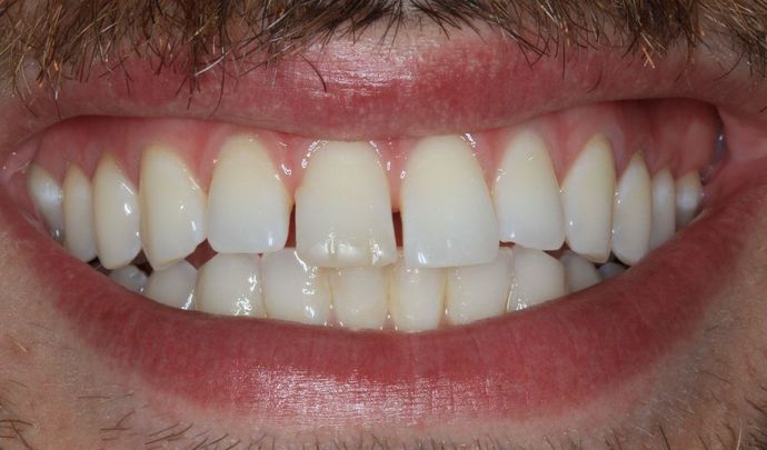 Invisalign Case 13 - Before