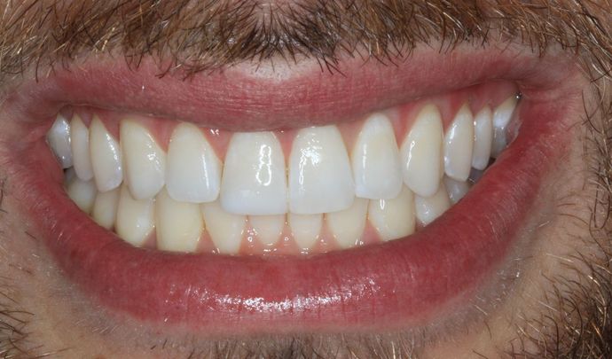 Invisalign Case 13 - After