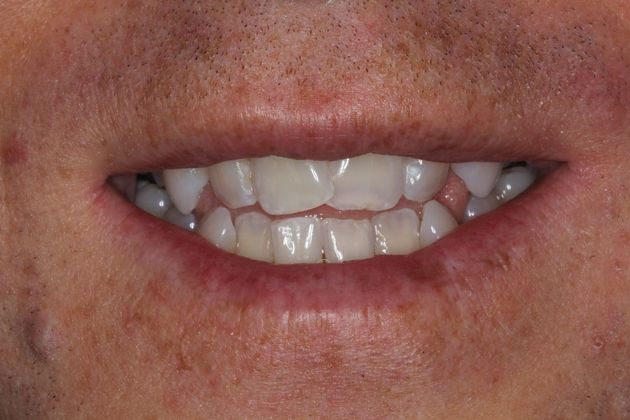 Invisalign Case 14 - Before
