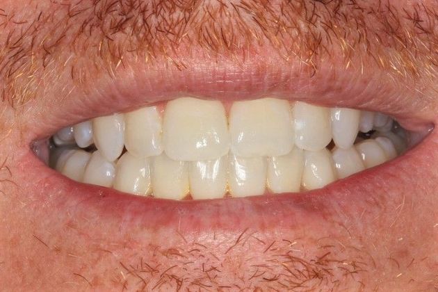 Invisalign Case 14 - After