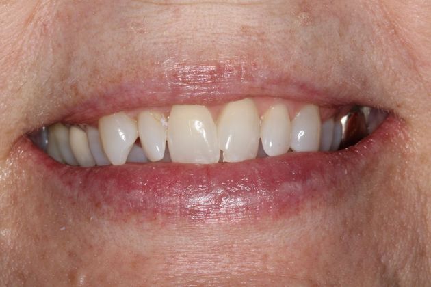 Invisalign Case 15 - Before