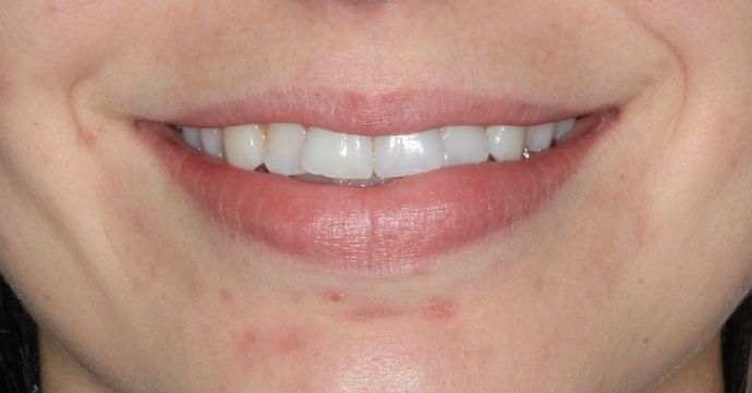 Invisalign Case 16 - Before