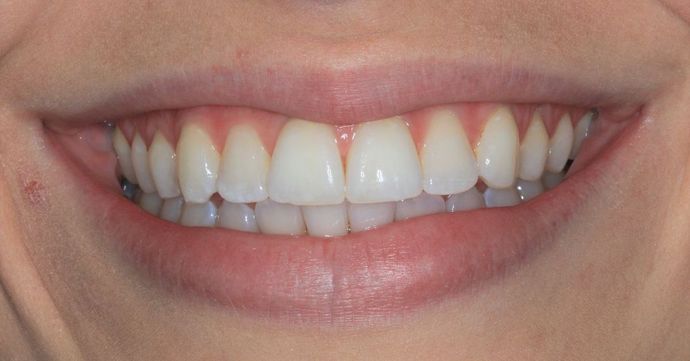 Invisalign Case 16 - After