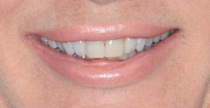 Invisalign Case 17 - Before